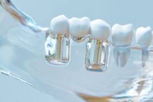 Multiple teeth Implants